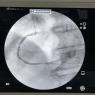 Angiografía coronaria derecha 