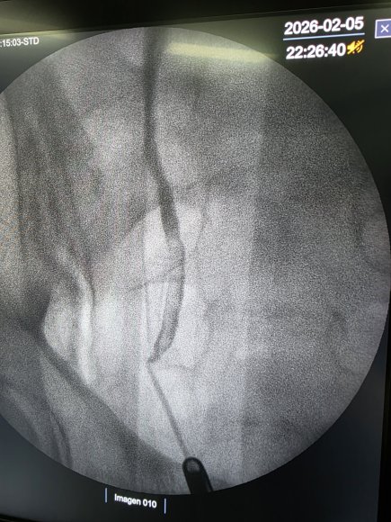 Escopia de un ureter renal con obtruccion proximal