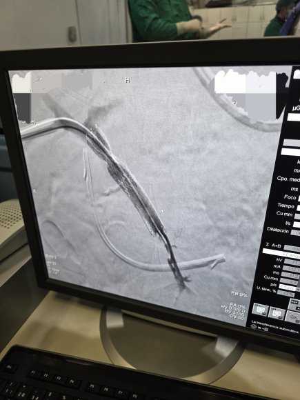 Estenosis de la vena porta con stent