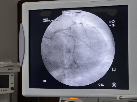 Cateterismo cardiaco izquierdo con varias lesiones 