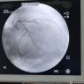 Cateterismo cardiaco con lesiones severas