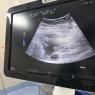 Imagen Ecografíca Absceso Abdominal