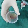 Muestra de Absceso abdominal 