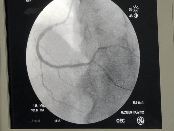 Coronaria derecha con stent