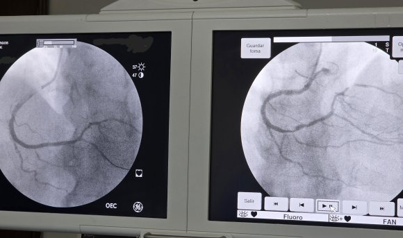 Angioplastia coronaria derecha